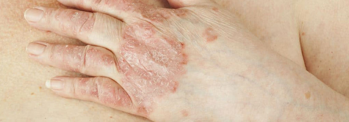 psoriasis