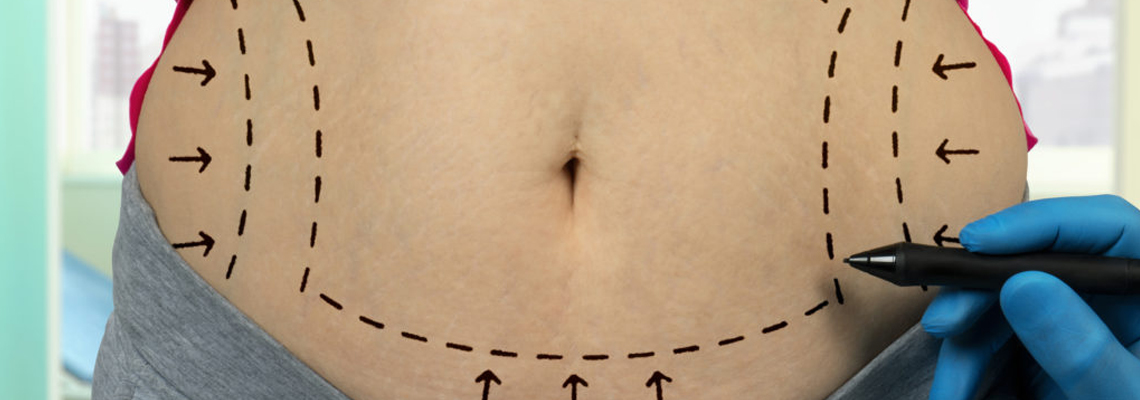 abdominoplastie